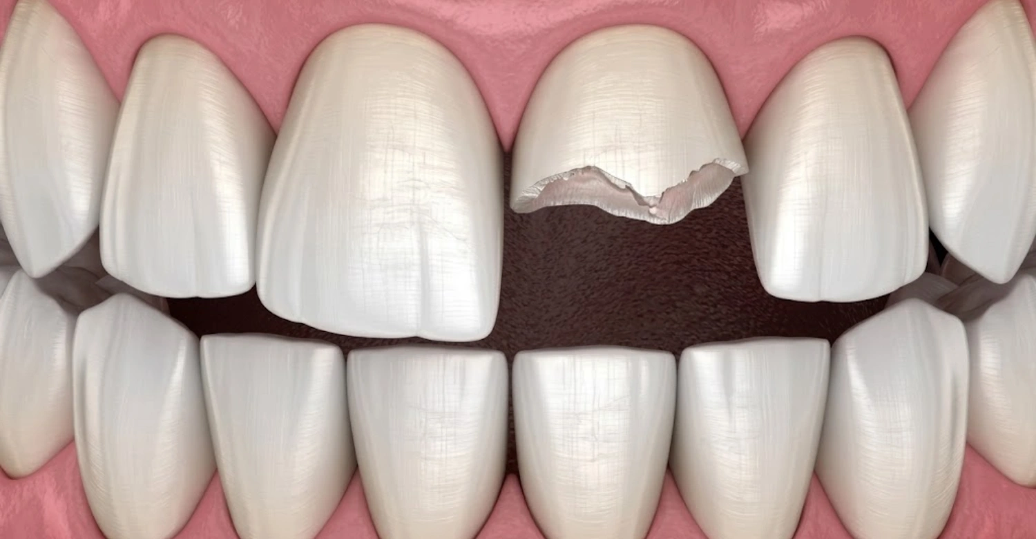 What to Do If a Tooth Is Knocked Out During Sports1